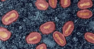 Wisconsin Reports Five mpox Cases, Urges Preventive Steps
