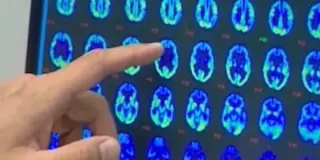 Hawaii Neurologist Outlines Key Indicators Distinguishing Normal Aging from Dementia