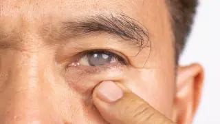 Diabetes pushes cataracts into younger years, doctors warn