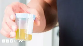 Home urine test could flag majority of bladder cancers, NHS trial finds