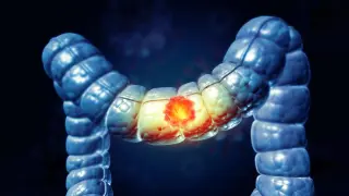 Pre-Surgery Immunotherapy Sparks Long-Term Remission in Colorectal Cancer