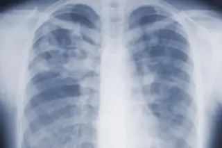 CDC study flags mold infections as an underrecognized hospital threat
