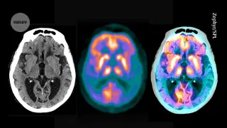 Atlas of brain microproteins offers new angles on Alzheimer’s