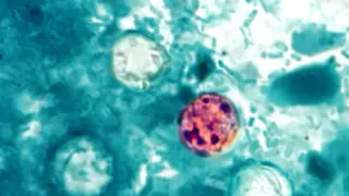 Michigan Braces for Rapid Cyclosporiasis Surge as Cases Climb Over 1,500