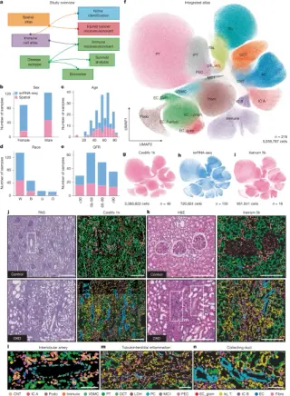B cell–driven Diabetic Kidney Disease uncovered by a high-resolution spatial atlas
