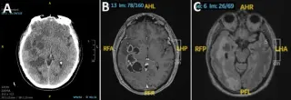 Brain lesion mystery solved: pork tapeworm masquerades as cancer