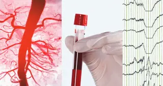 Cardiologists Debunk Cholesterol Myths as Misinformation Grows