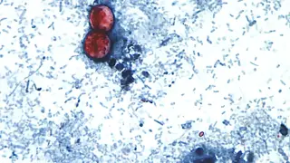 Michigan reports two cyclosporiasis deaths as outbreak climbs beyond 11,000 cases