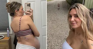 Mole Mistaken for a Freckle Turns Out to Be Melanoma During Pregnancy