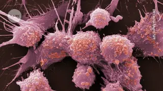 New PSA screening data hint at mortality benefit, but gains remain modest