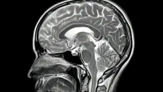Autopsy reveals uneven brain clearance by Alzheimer's drug