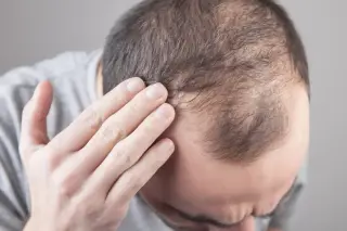 Arthritis drug prompts remarkable hair regrowth in severe alopecia areata, study finds