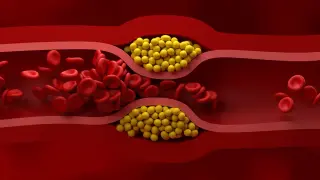 New US Guidelines Push Early Lipid Control to Fight Heart Disease