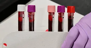 New Hematology Guidelines Lower Thresholds to Catch Undiagnosed Iron Deficiency