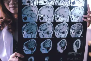Genetic Dementia: A Family’s Fight for a Cure
