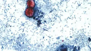 Michigan reports 2,600+ cyclosporiasis cases as hospitalizations rise