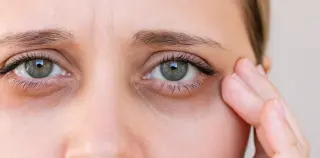 Ferritin Face Debunked: Skin Clues Don’t Confirm Iron Levels
