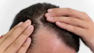 Arthritis drug sparks notable hair regrowth in alopecia trials