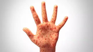 Mesa Emerges as New Front in East Valley Measles Outbreak
