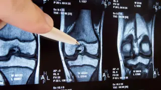 10-Year Trial Upends Common Knee Surgery: No Benefit, Potential Harm