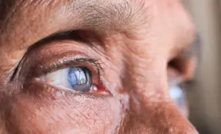 High-Dose Eye Supplements Slow AMD, But Not for Everyone