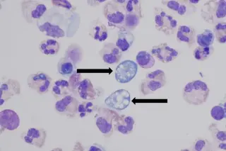 NC teen’s death highlights rare brain-eating amoeba linked to heat waves
