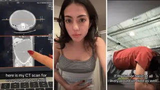 Fitness influencer discovers 18-pound ovarian cyst after years of misdiagnosed abdominal pain