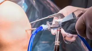 A Decade Later, Knee Arthroscopy Finds No Benefit for Degenerative Meniscal Tears