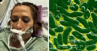 Tiny Wound, Big Risk: Vibrio Warning After Flesh-Eating Infection