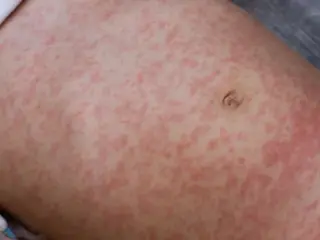 Maryland Declares Measles Outbreak in Three Counties Amid Surge in Unvaccinated Cases