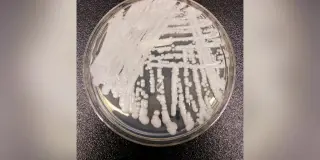 US Faces Widespread Spread of Candida auris Across 26 States