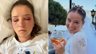 Bridal lash disaster: allergic reaction to extensions hours before wedding