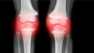 One-Shot OA Reversal in Animals Sparks Hope for Human Trials