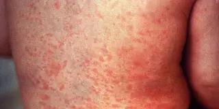 Maricopa County Records Sixth Measles Case, Exposures Flagged in Mesa and Queen Creek
