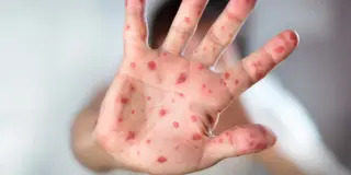 Huntsville Measles Case Traced to International Traveler