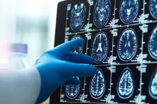 When the brain mispredicts: the reality of functional neurological disorder