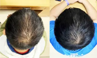 Plant-derived serum prompts rapid hair regrowth in early trial