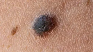 Personalized mRNA Vaccine Shows 42% Drop in Melanoma Recurrence in Phase 3 Trial