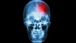 Skull Bone Marrow Linked to Chronic Pain Through Immune Signaling