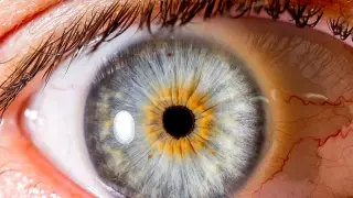 Stem-Cell Patch Rebuilds Cornea, Boosts Vision in Rare Eye Disorder