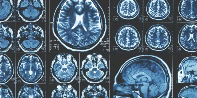 Brain scans reveal that neighborhood poverty, not innate IQ, drives key neural differences