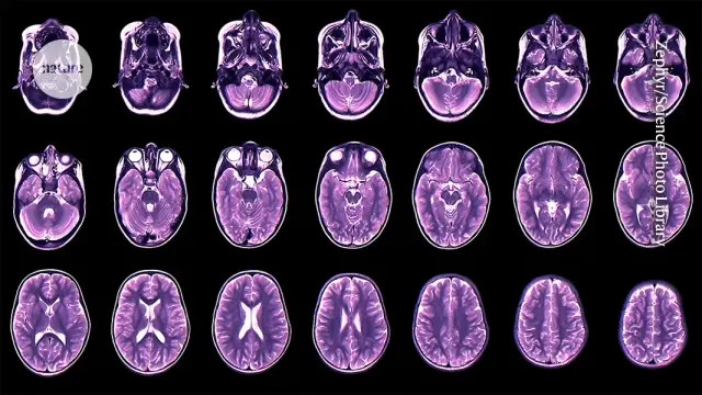 Cortical Thinning Timelines Predict Adolescent Mental Health Risks