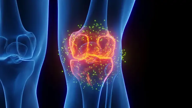 Yale Study Finds Epilepsy Drug Lacosamide May Reverse Osteoarthritis via Targeted Hydrogel Delivery