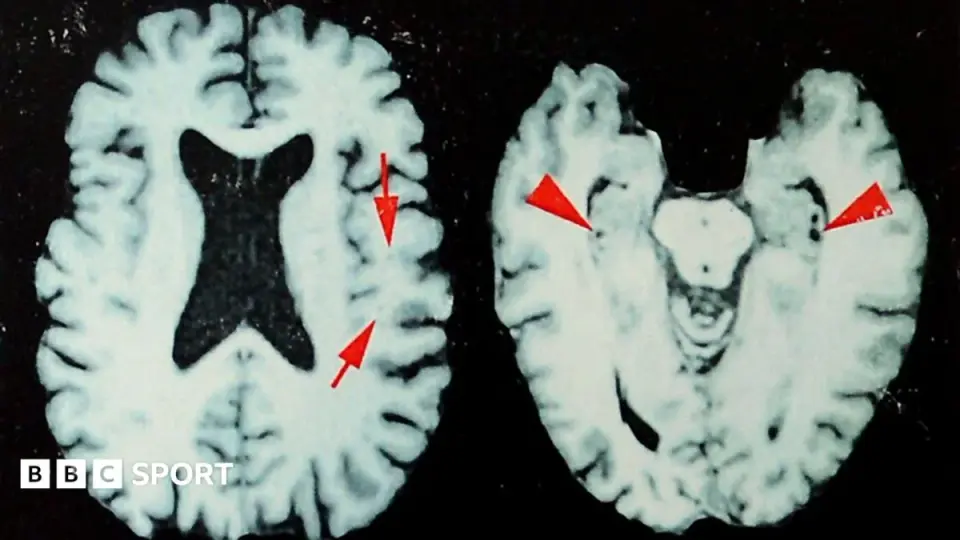 New study ties high CTE risk to former NFL players, urges safer head-impact limits