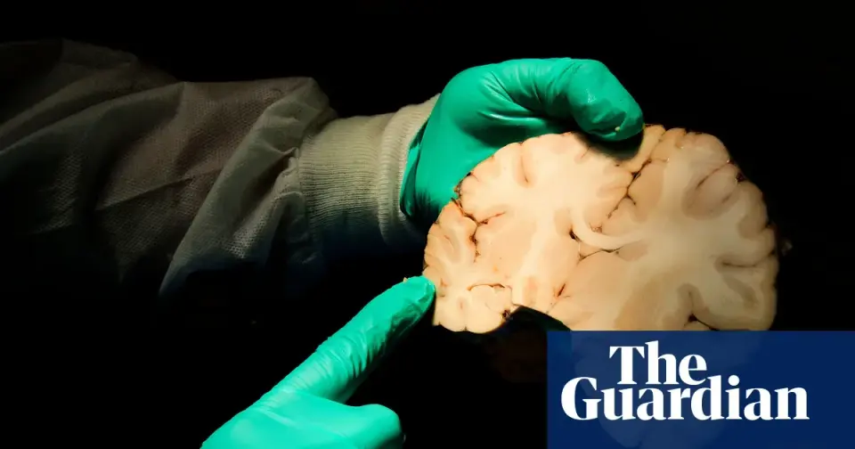 Study Finds 75% of Deceased Ex-NFL Players Had CTE, Far Higher Than General Population