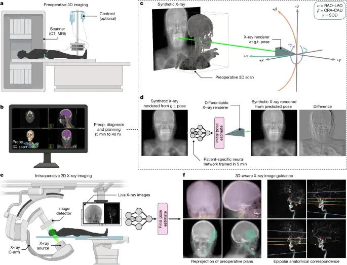 New AI tool aligns 3D scans with X-rays in seconds for surgery