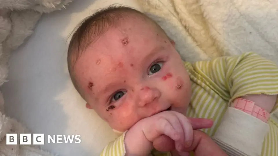 Parent of child with rare 'butterfly skin' disorder demands UK government increase research funding