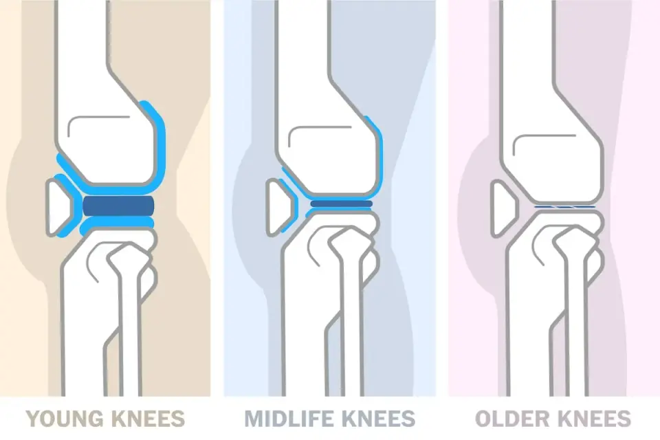 New research suggests knees are more resilient than previously believed, with activity key to long-term health