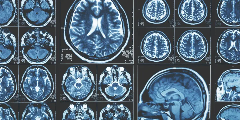 Brain patterns linked to IQ may actually reflect socioeconomic privilege, study finds