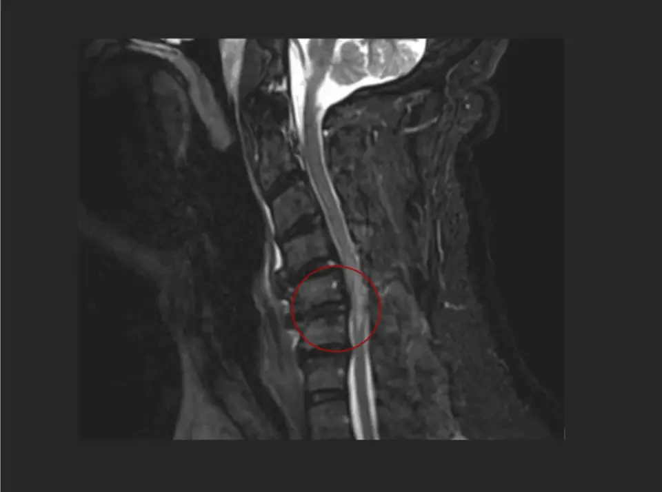 Spinal Imaging Masks Guillain-Barré Diagnosis in Post-Fall Patient